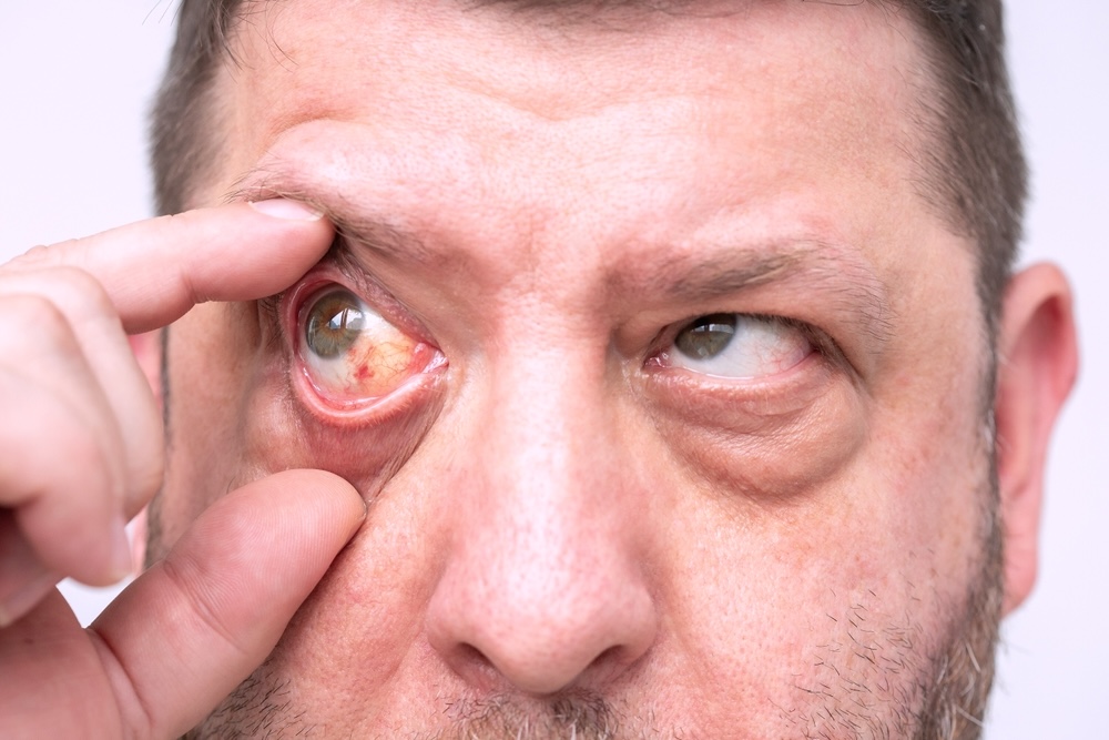 A close-up of a man's face with red eyes due to cocaine abuse