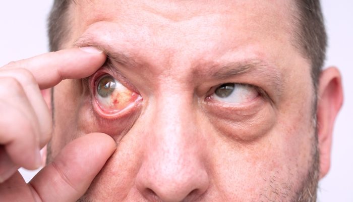 A close-up of a man's face with red eyes due to cocaine abuse