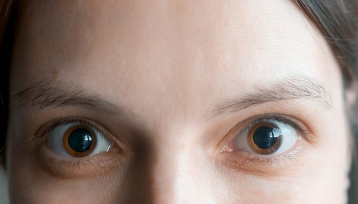 A close-up of a woman's face with dilated eyes due to cocaine addiction